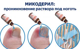 Billig kamp mot nagelsvamp