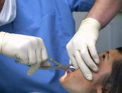 ¿Cómo detener la sangre después de eliminar el diente?