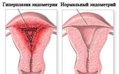 Normal endometrietjocklek i klimakteriet och funktioner i utvecklingen av endometriehyperplasi