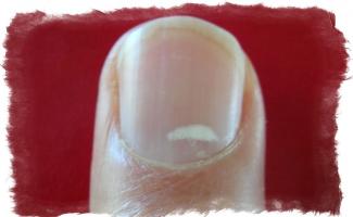 Why do white spots appear on nails?