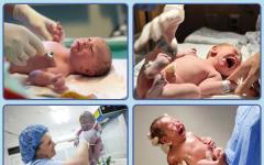 Procjena novorođenčadi pomoću Apgarove skale: dekodiranje
