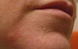 Peeling hud: orsaker och behandling