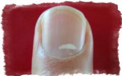 Why do white spots appear on nails?