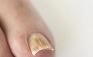 Thickening toenails - what is the cause Thick toenail treatment
